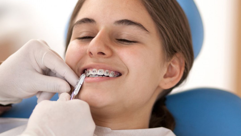 Tips to Reduce Braces Cost in Australia Without Sacrificing Quality