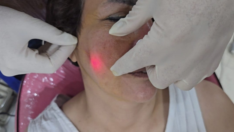 What Are The Areas Can Endolift Treat?