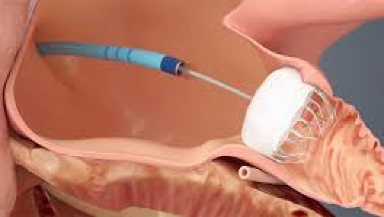 Atrial Fibrillation Device Market: Accelerators Driving Innovation and Global Growth