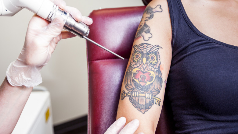 Best Time to Get Picosure Tattoo Removal for Smooth Results