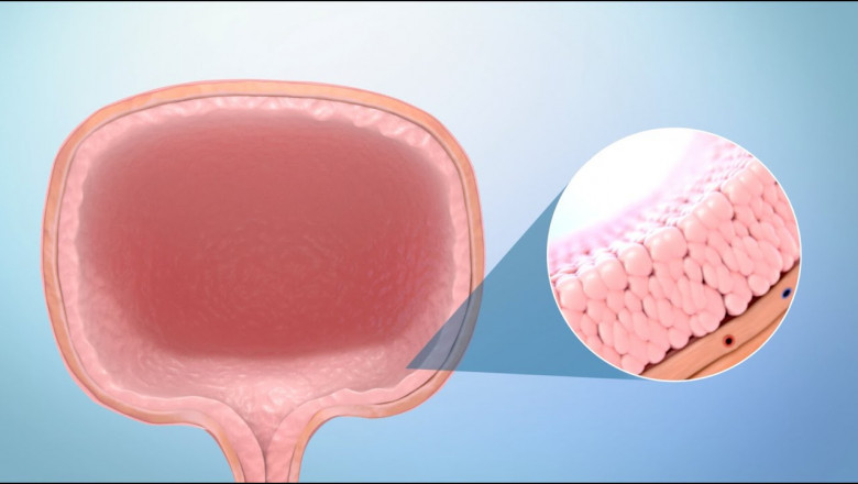 Non Muscle Invasive Bladder Cancer Market to Soar on Novel Immunotherapy Advances