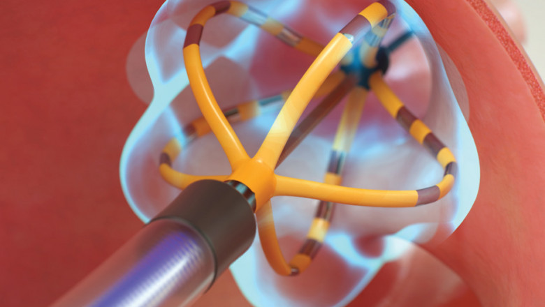 Pulsed Field Ablation Market to Surge Owing to Ultra-High-Frequency Pulse Technology