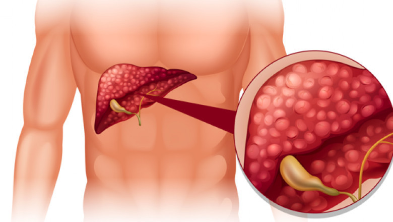 Understanding Fatty Liver Disease: Importance of Early Detection and Health Checkups