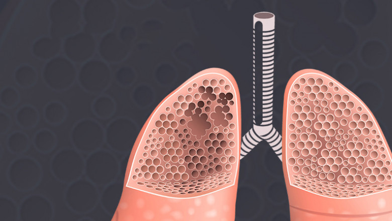 Emphysema Market Is Anticipated to Witness High Growth Owing to Rising Adoption of Inhalation Therapies