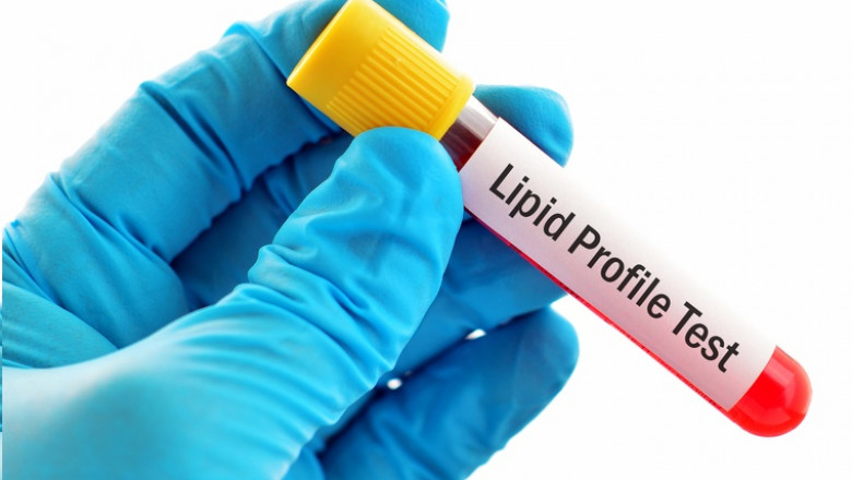 High Cholesterol: How a Lipid Profile Test Can Help You Manage It
