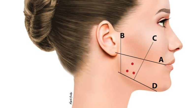 How Masseter Botox Relieves TMJ Disorders