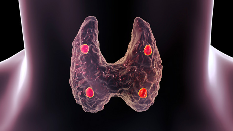 Hyperparathyroidism Treatment Market is Set to Witness Growth Owing to Novel Calcimimetics