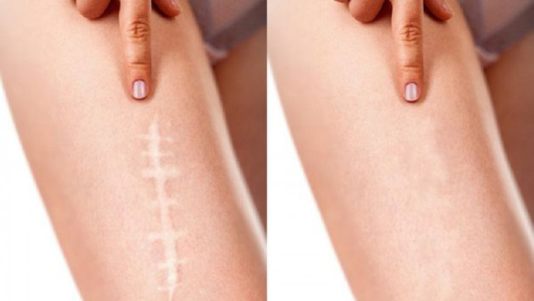 Hypertrophic Scar Market Projected to Surge with Innovative Laser Therapies