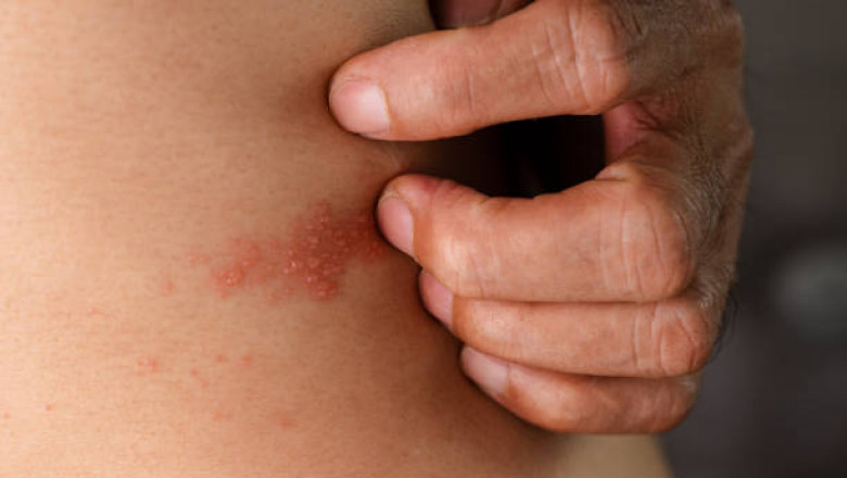 Learn about shingles with pictures: symptoms and treatment