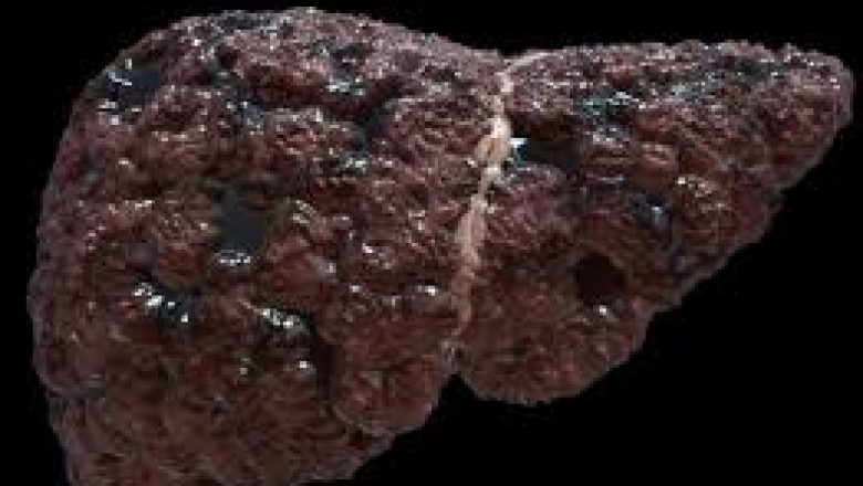 Liver Cirrhosis Market to Surge with FibroScan Technology