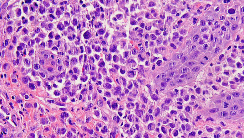 Paraganglioma Market is Estimated to Witness High Growth Owing to Advanced Imaging