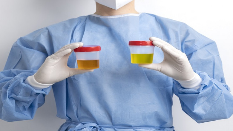 What You Need to Know About Urine Tract Infections (UTIs)