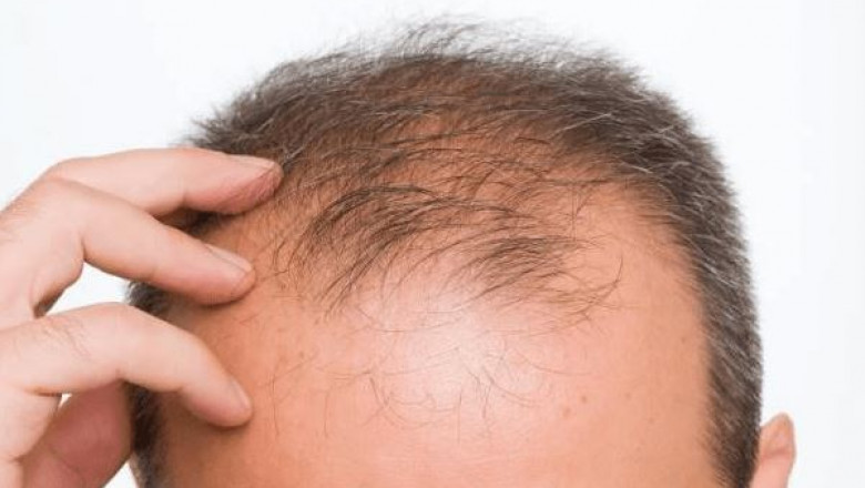 Cutting-Edge Recovery: Hair Transplants in the Digital Age