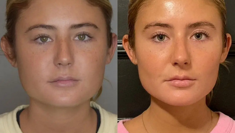 Is There Any Scarring After Buccal fat removal in Dubai?