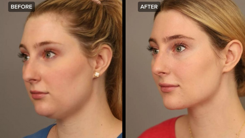 Reveal Your Best Profile with Chin Liposuction