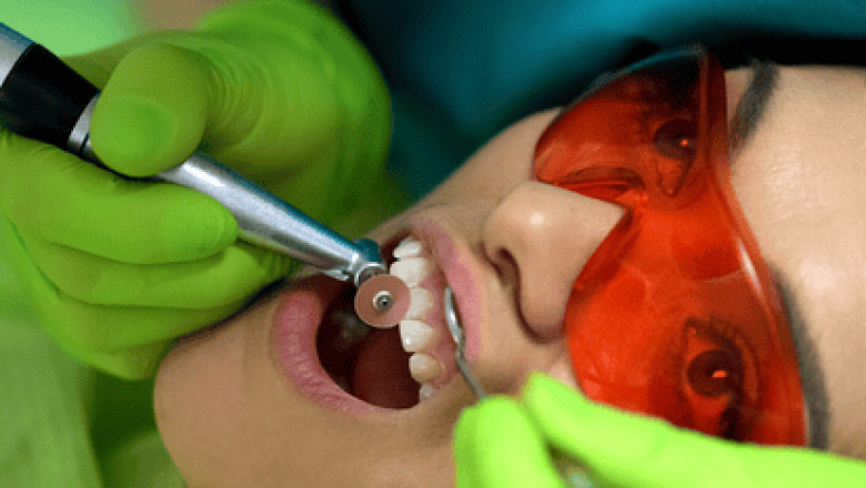 Tooth Polishing : Benefits, Cost and Tips