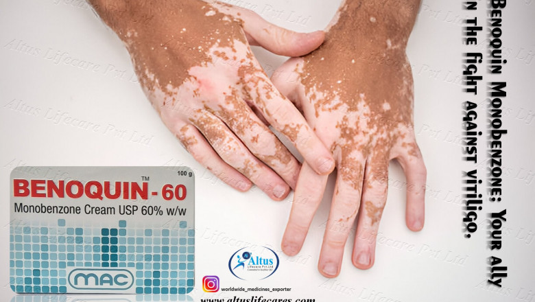A Comprehensive Guide to Benoquin 60 Cream for Vitiligo: Uses, Results, and Care