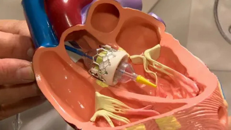 A Comprehensive Guide to Transcatheter Aortic Valve Implantation