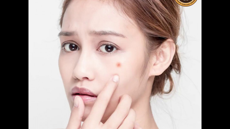 Anti-Acne Dermal Patch Market Forecast: Trends, Growth, and Future Opportunities Through 2030
