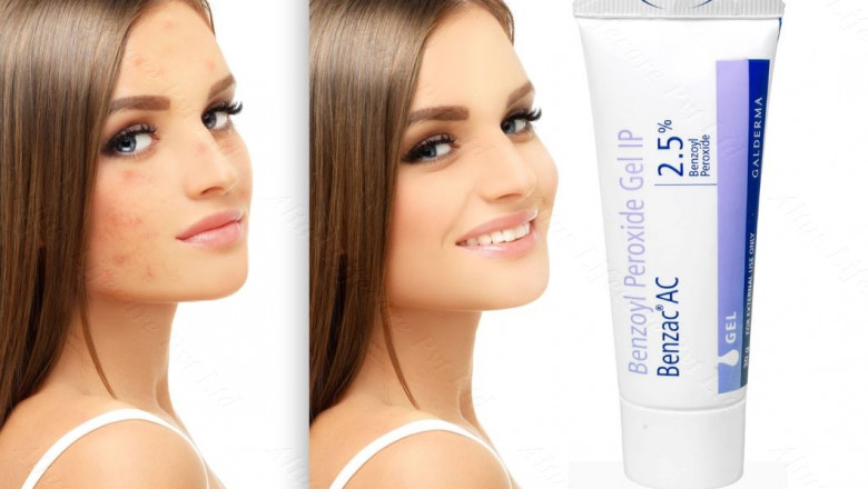 Benzoyl Peroxide Gel: Your Ultimate Solution to Acne Breakouts!
