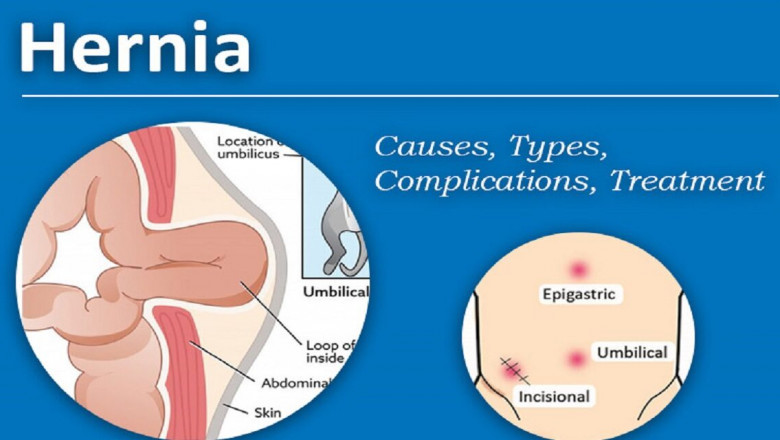 Best Hernia Specialist in Chennai – Dr Pinak Dasgupta