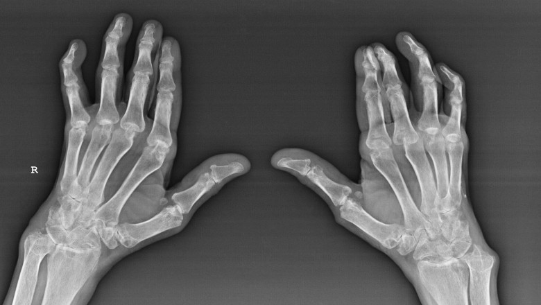 Erosive Hand Osteoarthritis Market to Surge Owing to Rising Geriatric Incidence
