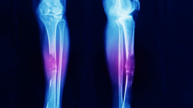 Ewing Sarcoma Treatment Market is Anticipated to Witness High Growth Owing to Innovative Targeted Therapies