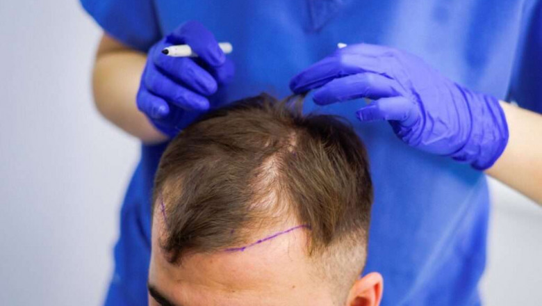 Hair Replacement: Modern Solutions for Hair Loss