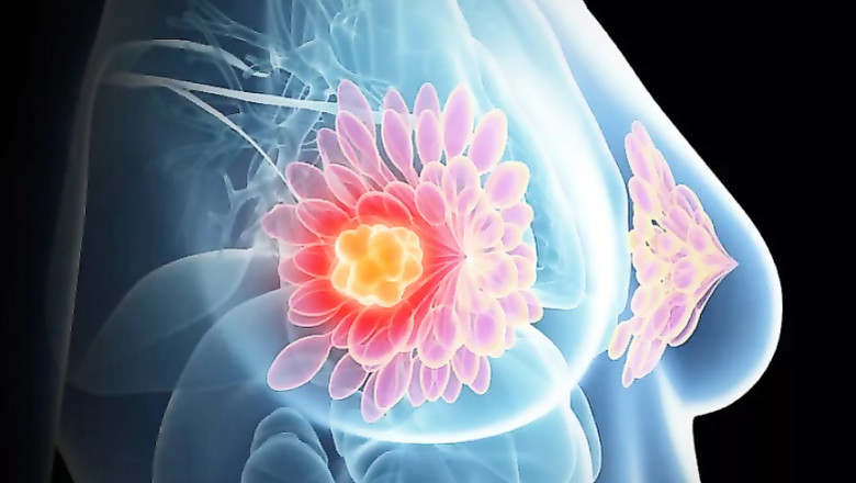 HER2-Positive Breast Cancer Market to Grow on Precision Therapy Advances