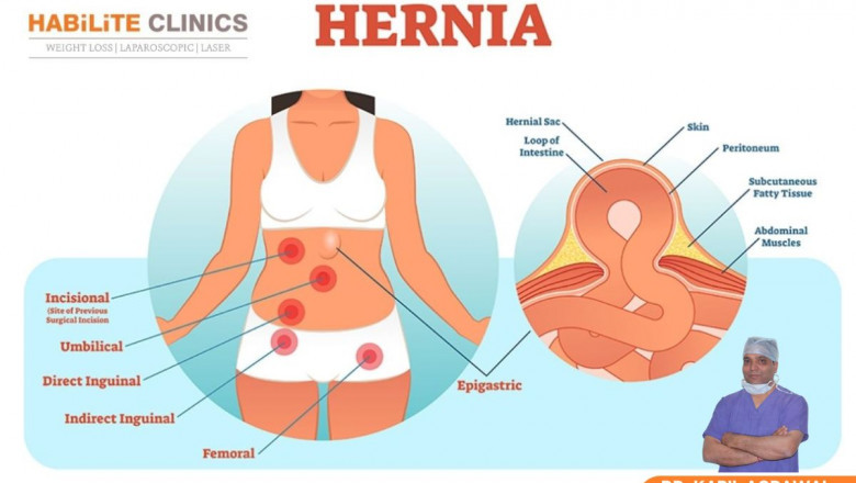 Incisional Hernia Treatment: Causes, Symptoms, and Surgical Options