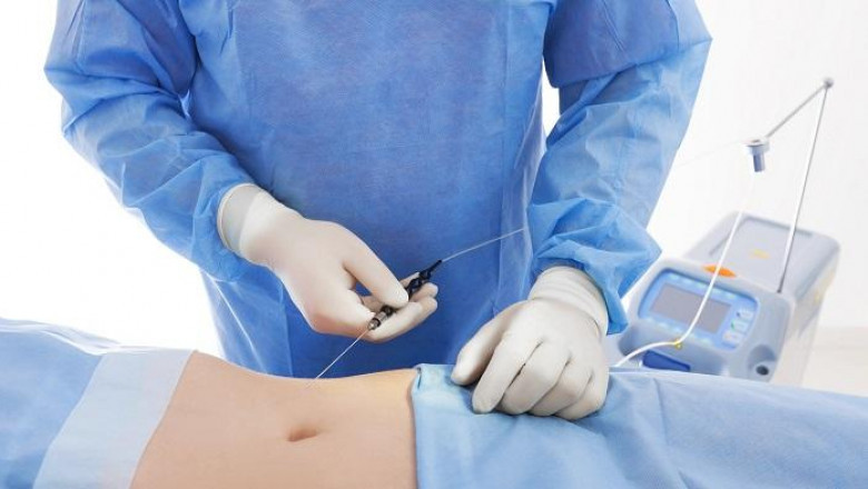 Liposuction Surgery Devices Market Booms with Laser-Assisted Technology