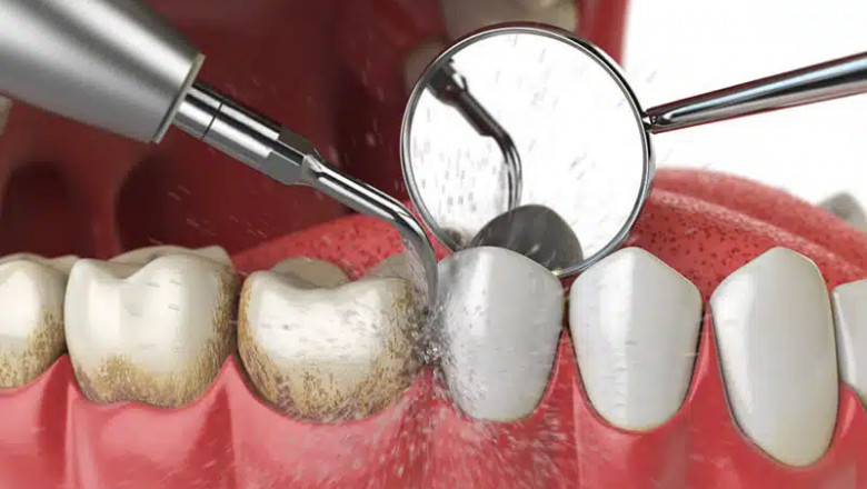 Luxury Dental Care Teeth Cleaning at a Fraction of the Price in Dubai