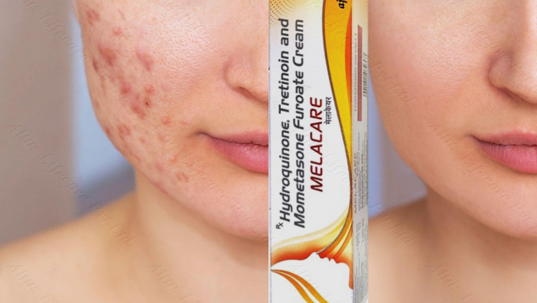 Melacare Forte Cream: The Celebrity-Approved Beauty Secret Exposed!