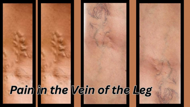 Pain in the Vein of the Leg: Causes, Symptoms, and Solutions