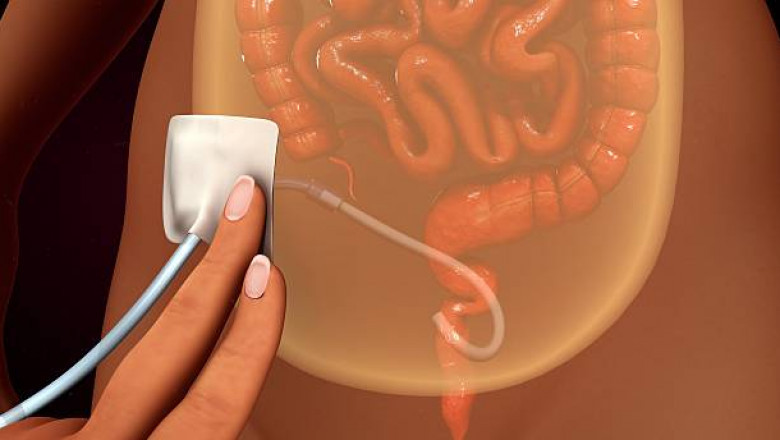 Peritoneal Cancer Market to Witness High Growth Owing to Precision Oncology
