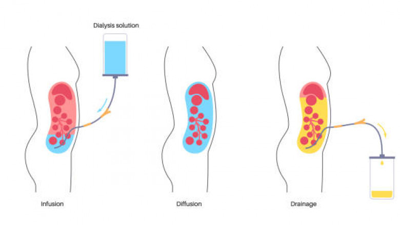 Peritoneal Dialysis Equipment Market Growth with Automated Cycler Technology