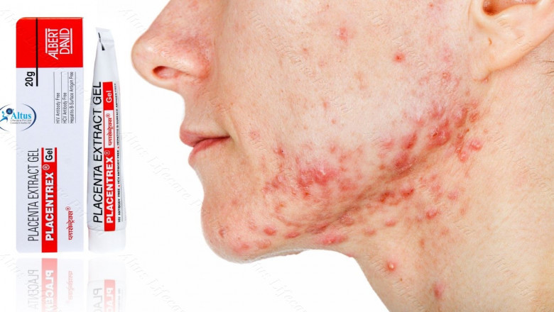 Placentrex Gel: Your Ticket to Ageless Beauty – See It to Believe It!
