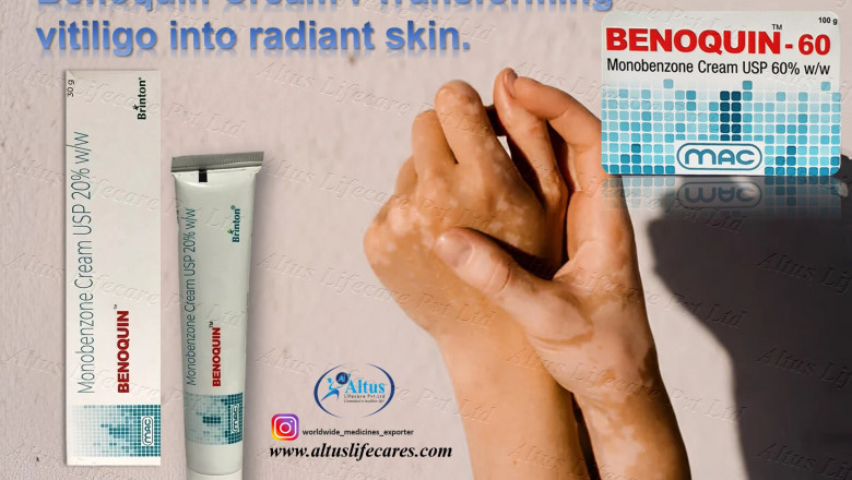 Vitiligo Treatment with Benoquin 60 Cream: Is It the Solution You’ve Been Waiting For?
