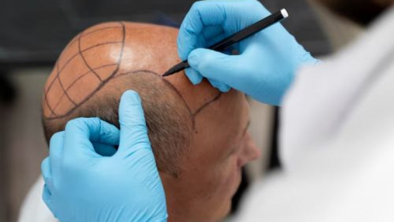 What is Required for Hair Transplant?
