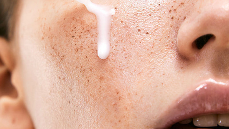 Anti-Acne Serum Market Forecast: Growth Drivers, Trends, and Opportunities Through 2035