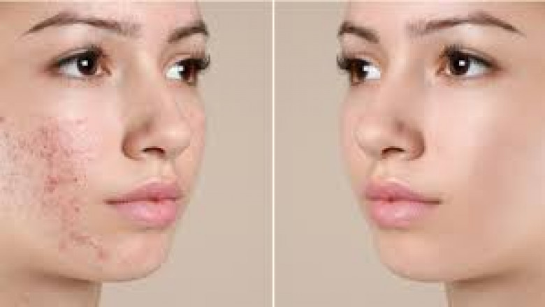 Effective Acne Treatment in Dubai: Options and What to Expect