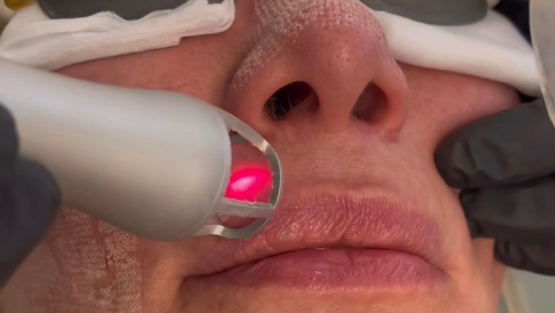 Fractional CO2 Laser Downtime: Recovery Timeline Explained