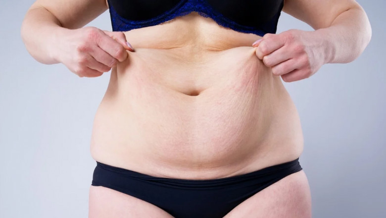 Tummy Tuck Dubai: What Are the Different Types of Incisions Used in Tummy Tuck Surgery