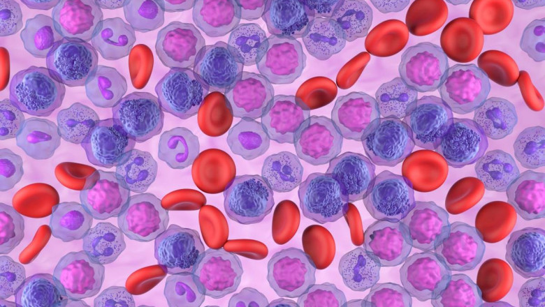 AML Market is Estimated to Witness High Growth Owing to Targeted Therapies