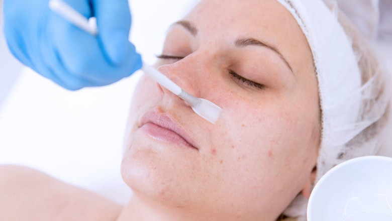 Chemical Peels Cost: What You Should Know Before Booking