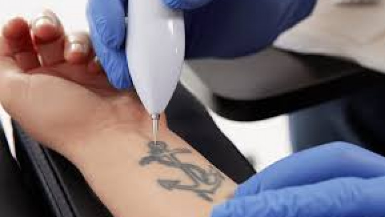 How Painful Is Laser Tattoo Removal Compared to Getting a Tattoo?