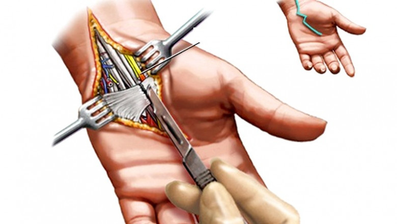 Carpal Tunnel Release System Market to Soar Amid Minimally Invasive Innovations