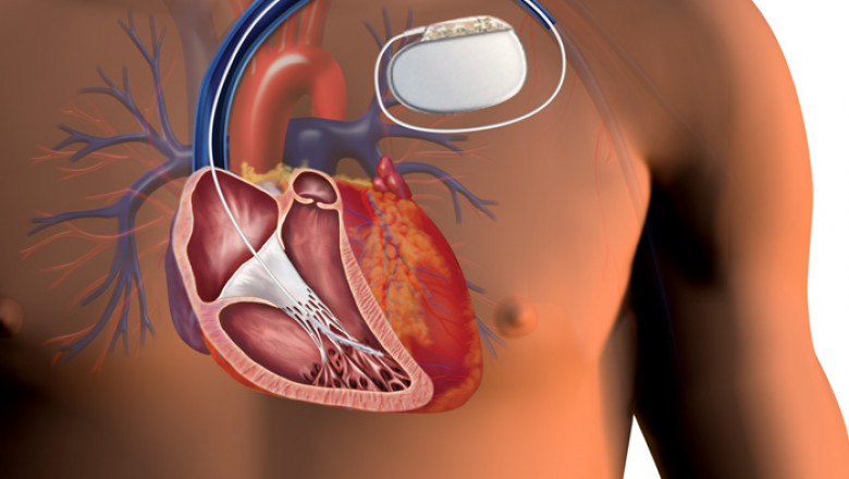 Implantable Cardiac Monitors Market to Surge with Wireless Connectivity