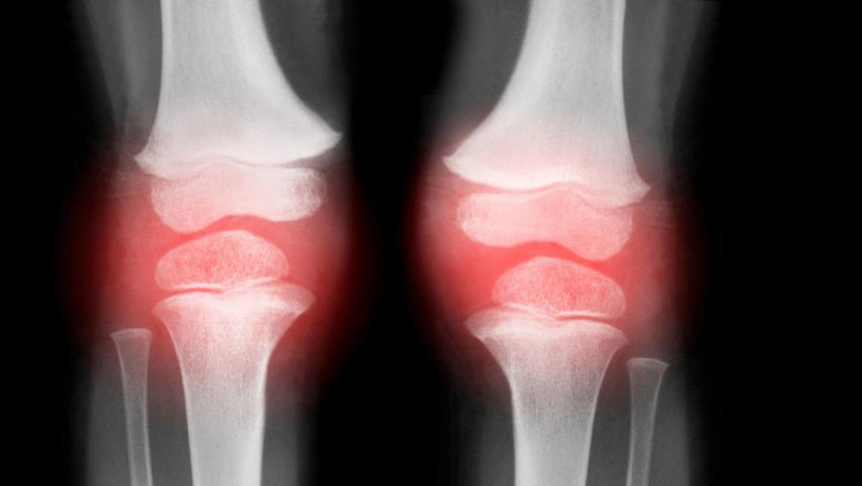Knee Osteoarthritis Market Set to Soar with Nanogel Therapeutics