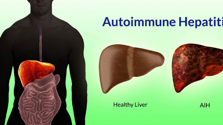 Autoimmune Hepatitis Market Poised for Growth with Targeted Immunotherapies
